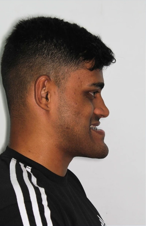 Antes da cirurgia ortognática: perfil de paciente masculino com aparelho ortodôntico.