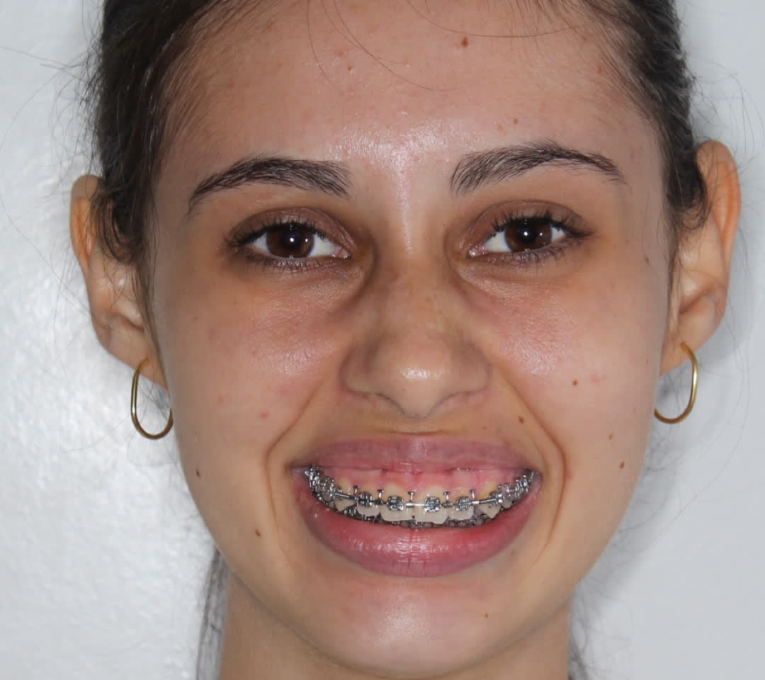 Antes do tratamento: registro frontal do rosto da paciente, sorrindo, com aparelho ortodôntico.